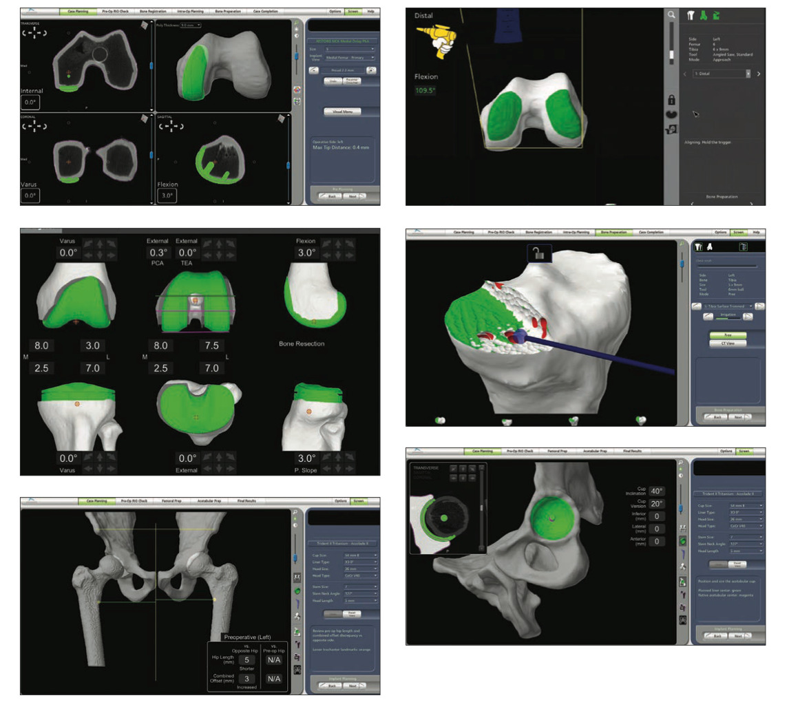 Robotic-arm assisted hip and knee replacement